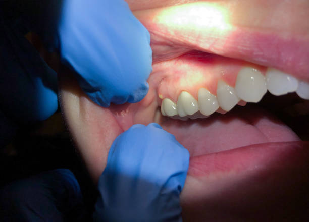 Best Emergency Dental Care for Abscessed Tooth in Rockaway Beach, OR