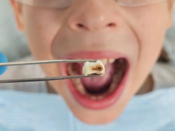 Best Emergency Dentist for Knocked-Out Tooth in Rockaway Beach, OR